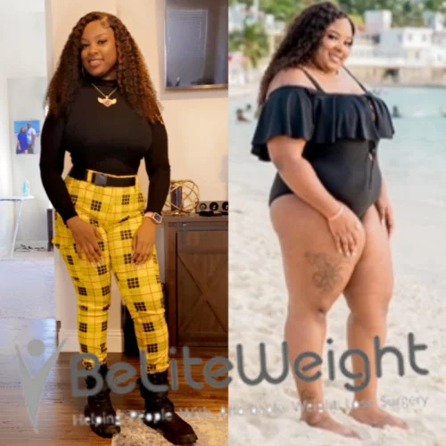 Weight Loss Surgery Before And After